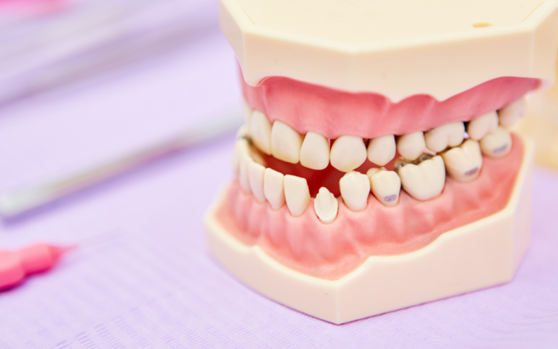 Malocclusione dentale: come riconoscerla e risolverla per un sorriso sano e armonioso